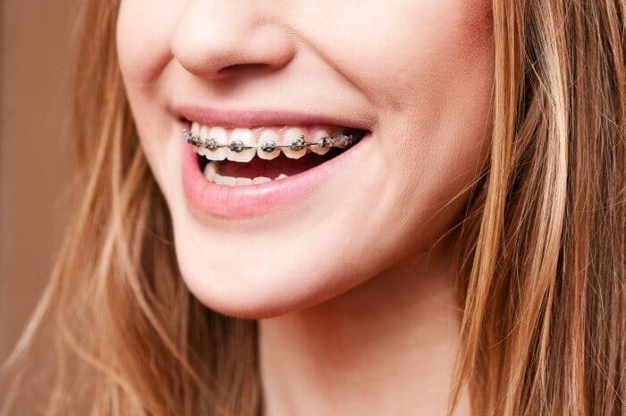 braces