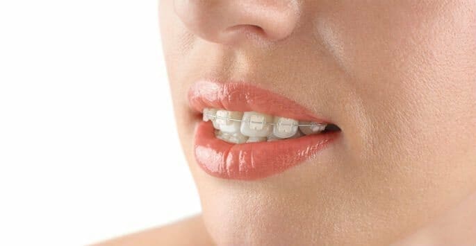 How to Keep Clear Braces Clean