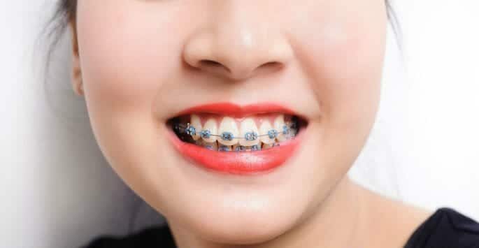 braces