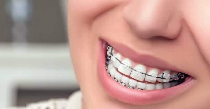 keeping braces clean