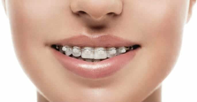 braces