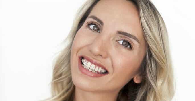 braces for adults